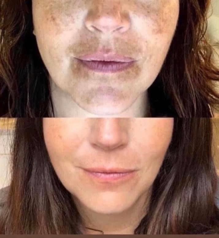 Before and after skincare results showing improvement in uneven skin tone, visible discoloration, and skin texture