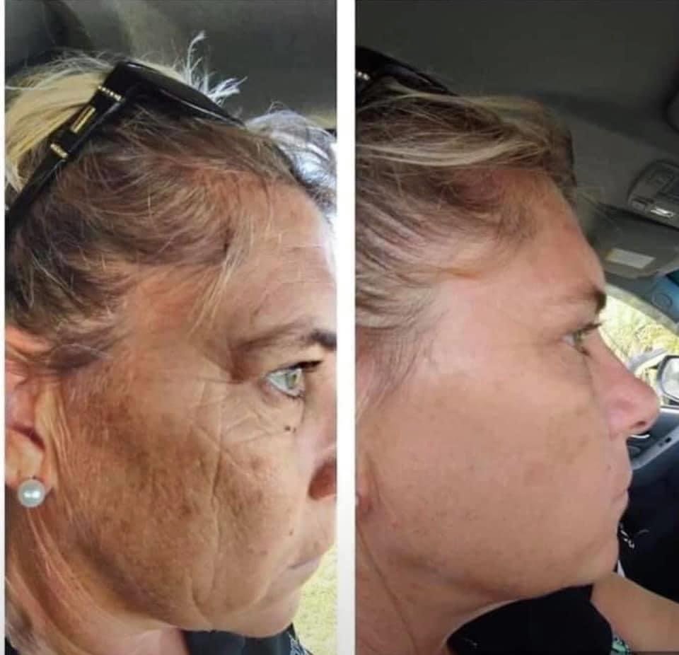 Before and after Age IQ skincare results showing visible improvement in skin tone, texture, and overall skin appearance