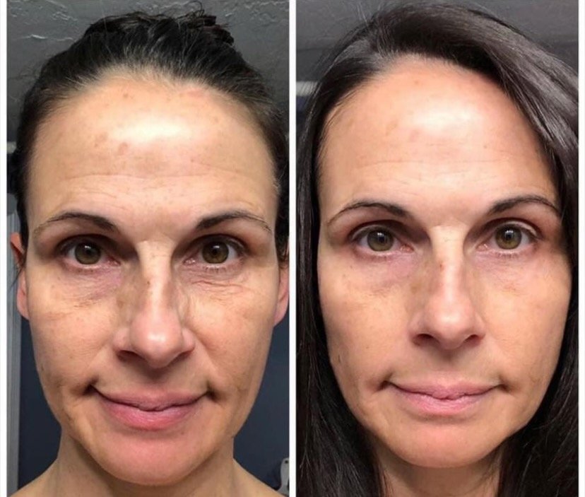 Before and after Age IQ skincare results showing visible improvement in uneven skin tone, redness, and skin texture
