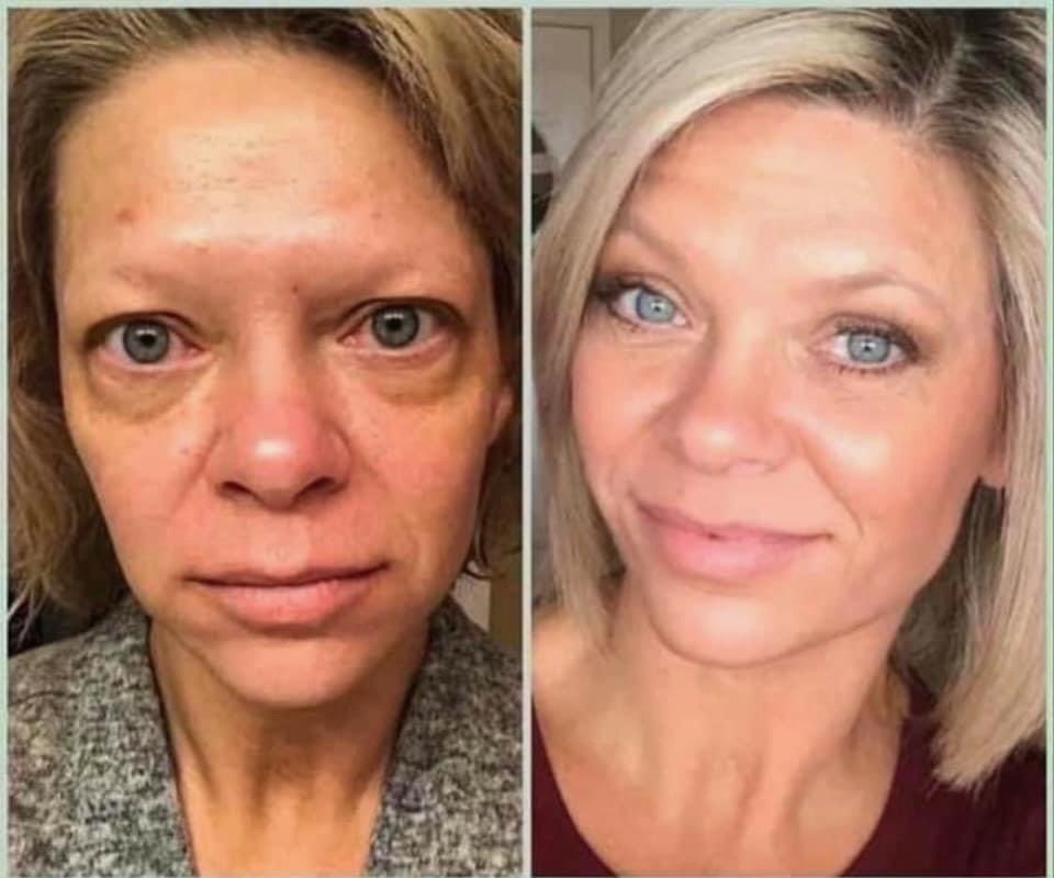 Before and after Age IQ skincare results showing improvement in visible redness, uneven skin tone, and skin texture