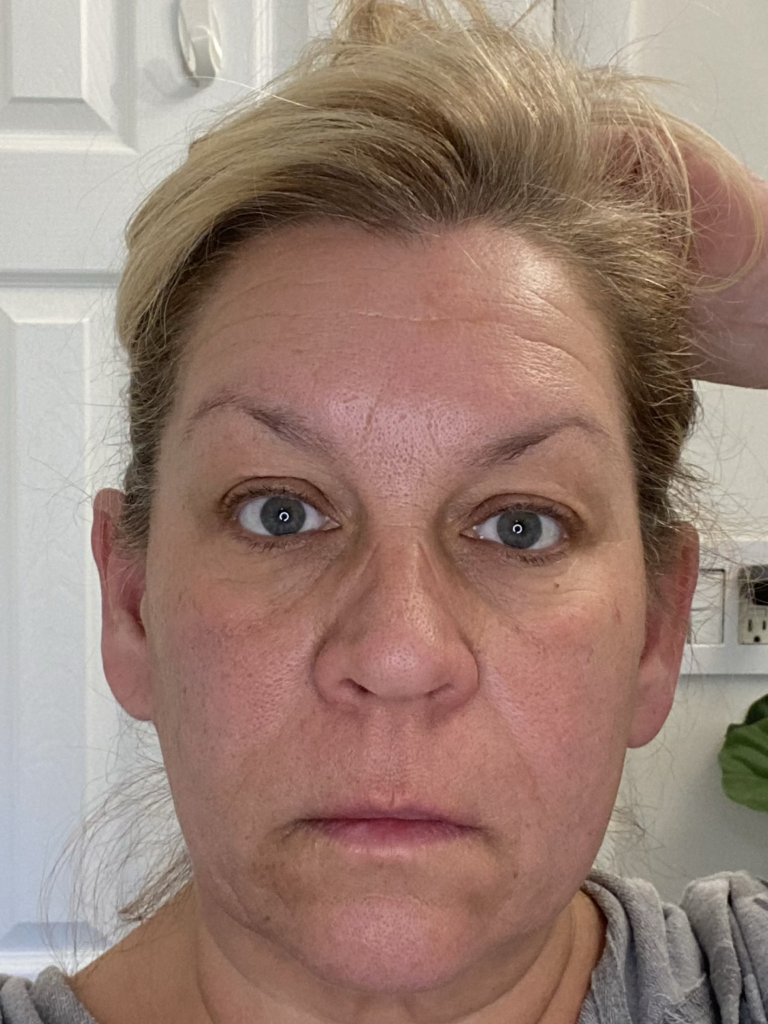 Lisa Cocchi skincare journey progress photo showing visible skin changes